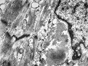 M,47y. | hypertrophic cardiomyopathy - left ventricle